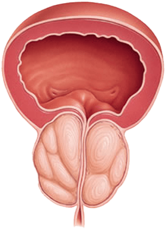 an illustration of bladder before using ProstaGenix