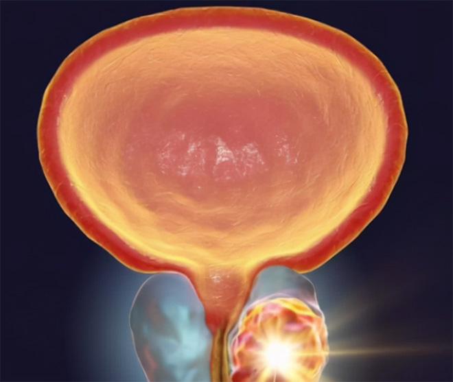 prostate